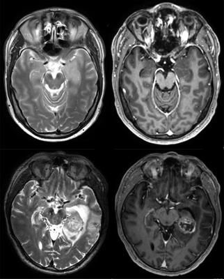 Clinical, radiological and pathological features of temporomesial tumors in the adult. A single center experience from 15 years